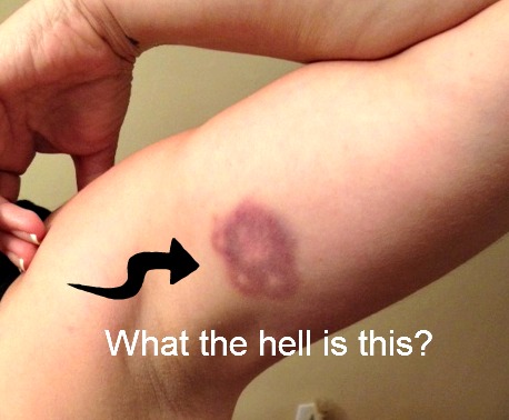 Can You Guess How I Got This Bruise?